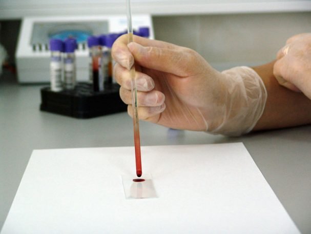 Chronic Fatigue Syndrome Breakthrough Boosts Cure Hopes2